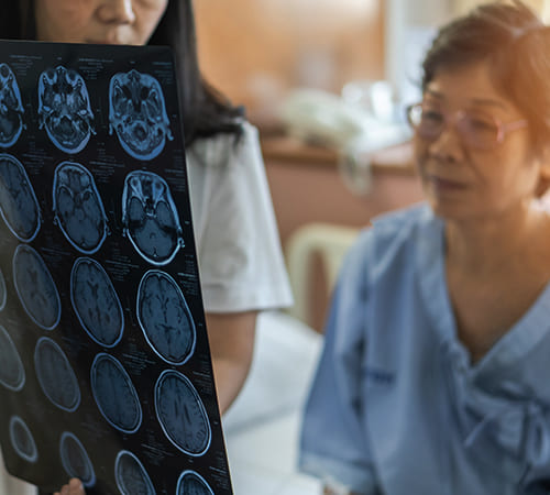 Best Neurologist for Strokes in Secunderabad