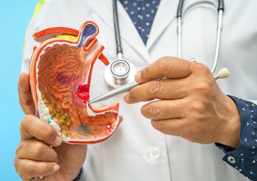 Stomach Ulcer Hospital in Secunderabad