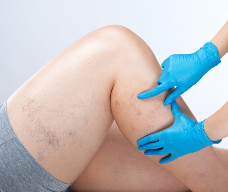 Arterial Vascular Disease Treatment