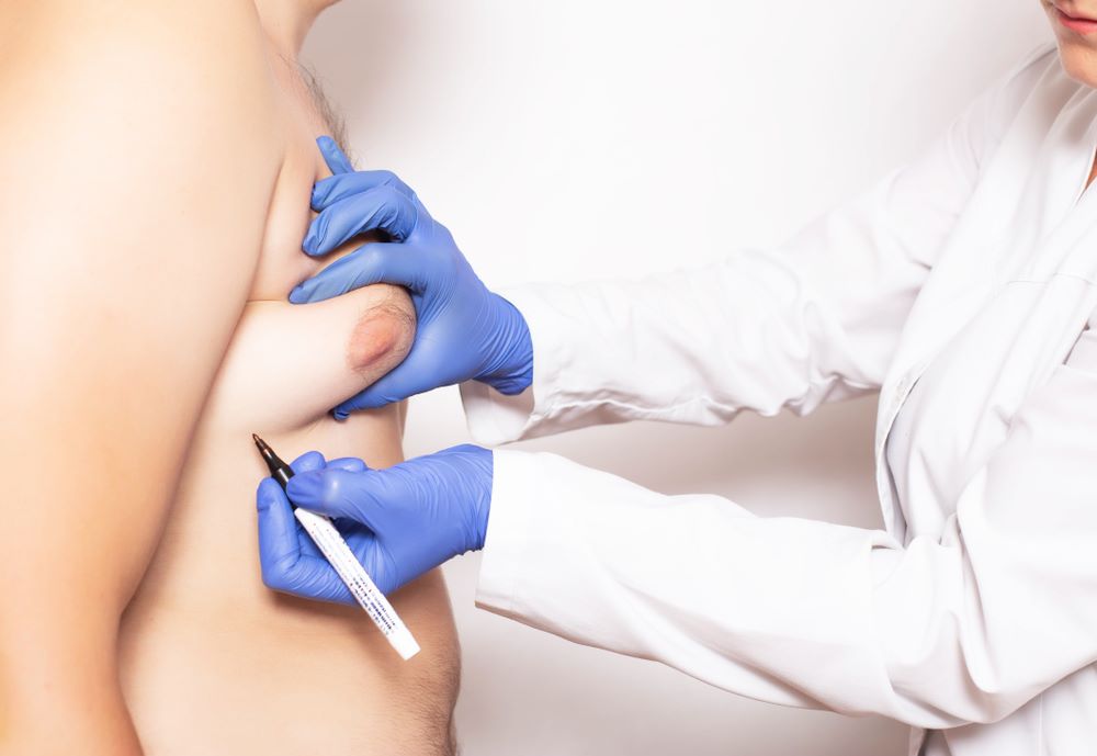 Gynecomastia surgery in Secunderabad