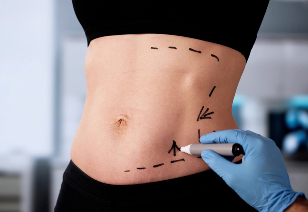 Liposuction surgery in secunderabad