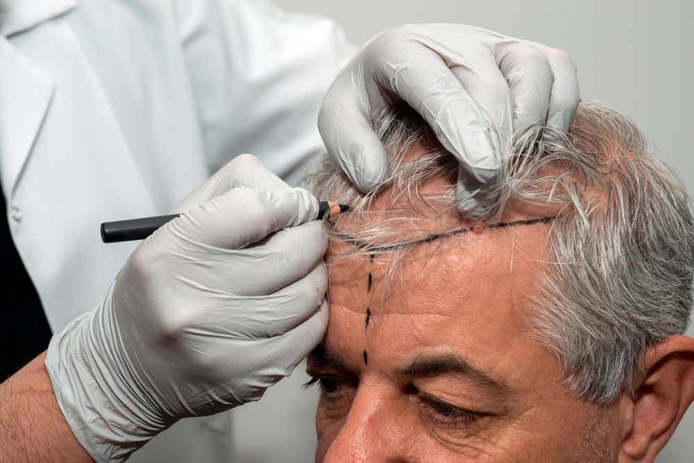 Best Hair Transplant in Secunderabad