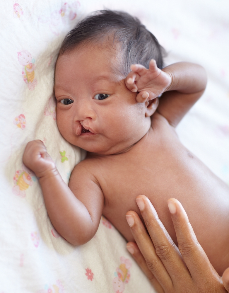 Cleft Palate Surgery in Secunderabad