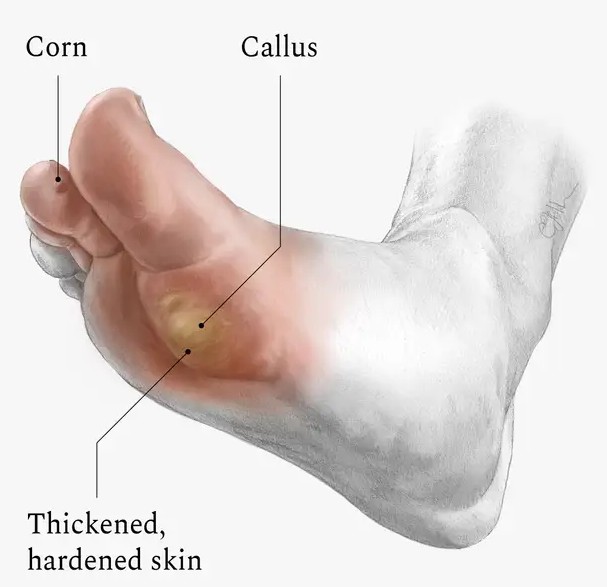Heel Pain Treatment Hospital in Secunderabad