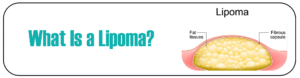 What Is a Lipoma 