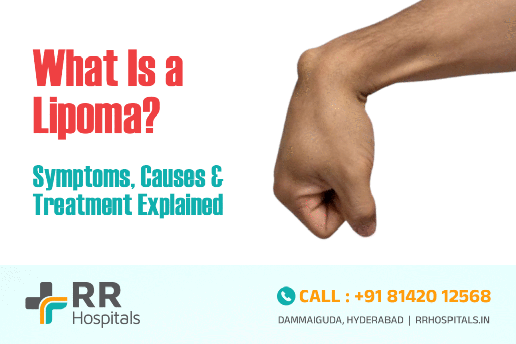 What Is a Lipoma