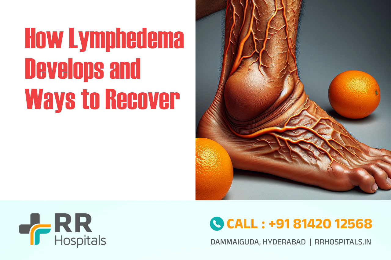 lymphedema