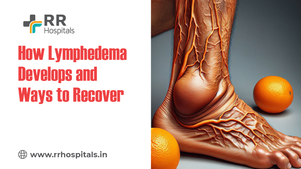 lymphedema